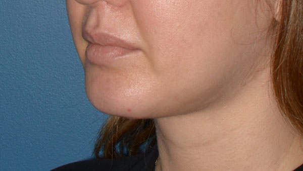 Chin Implant