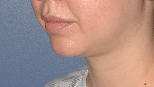 Chin Implant