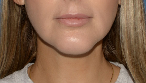 Chin Implant