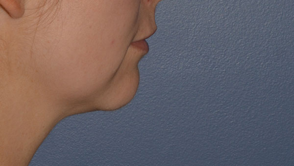 Chin Implant