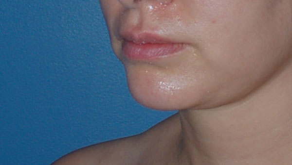 Chin Implant