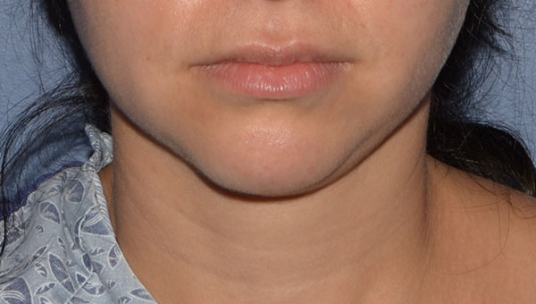 Chin Implant