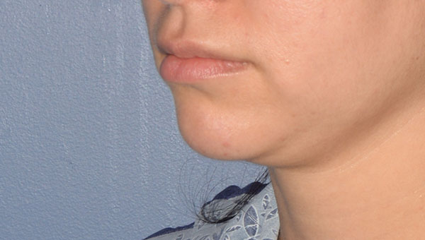 Chin Implant