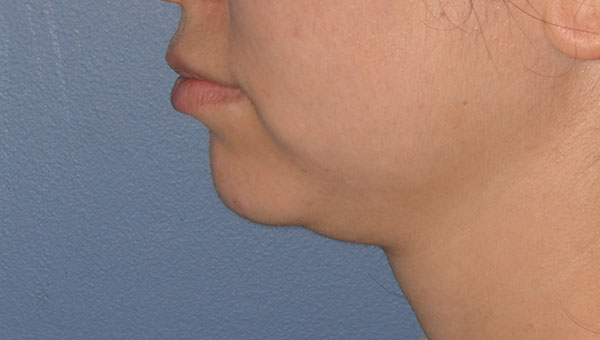 Chin Implant