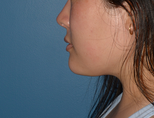 Chin and Jawline Liposuction