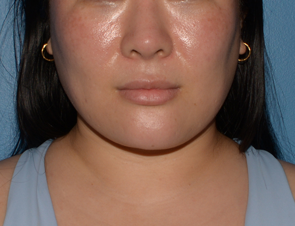 Chin and Jawline Liposuction