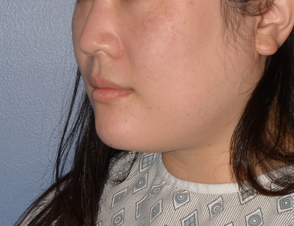 Chin and Jawline Liposuction