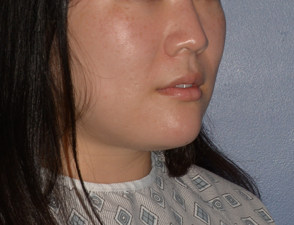 Chin and Jawline Liposuction