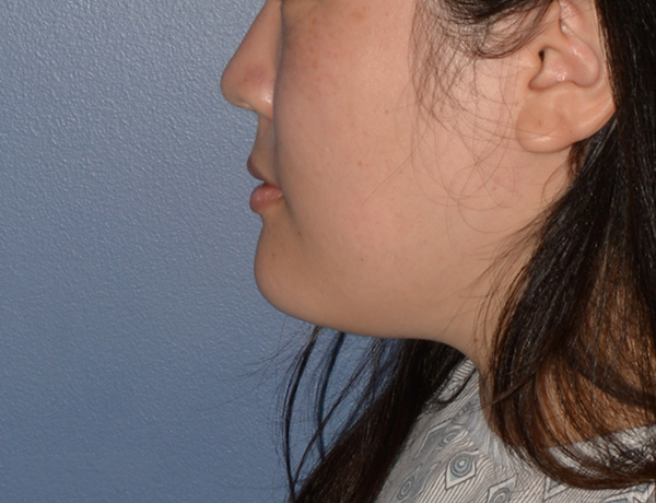 Chin and Jawline Liposuction