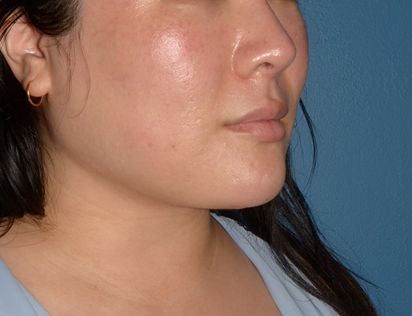 Chin and Jawline Liposuction