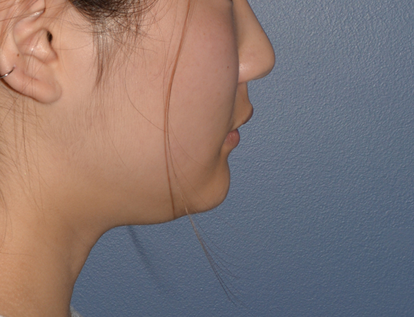 Chin and Jawline Liposuction