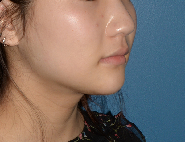 Chin and Jawline Liposuction