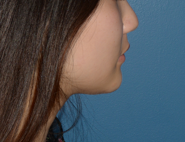 Chin and Jawline Liposuction