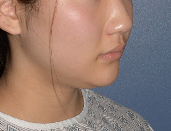 Chin and Jawline Liposuction