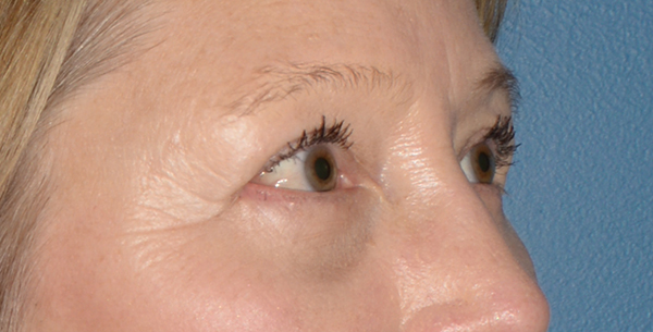 Eyelid Lift