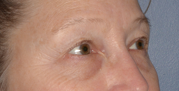 Eyelid Lift