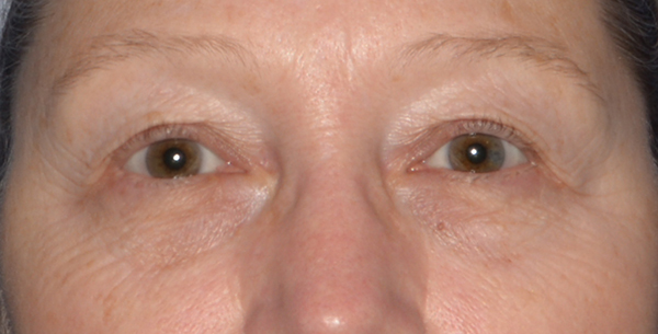 Eyelid Lift