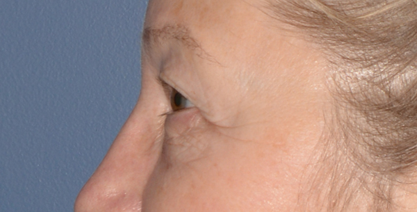 Eyelid Lift