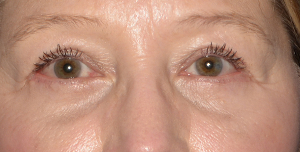 Eyelid Lift