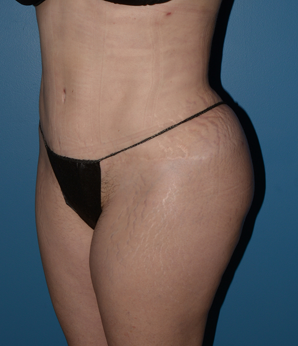 Liposuction