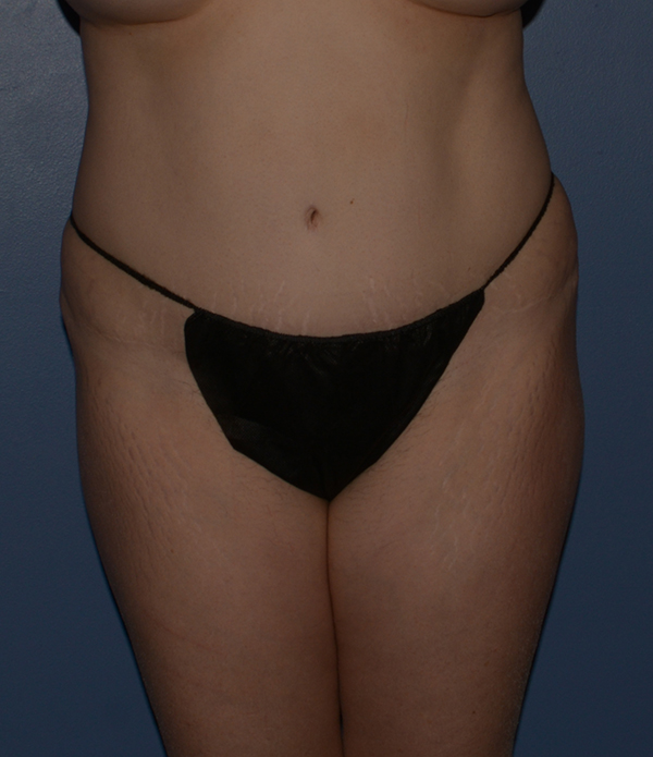 Liposuction