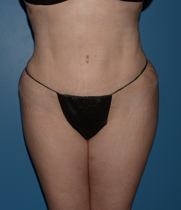 Liposuction