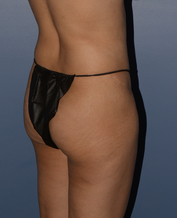 Butt Gluteal Implants