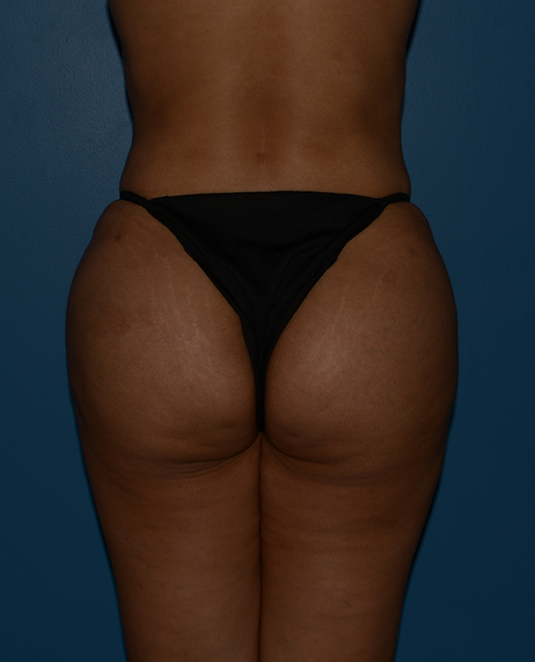 Butt Gluteal Implants