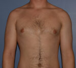 Male Breast Reduction