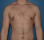 Male Breast Reduction