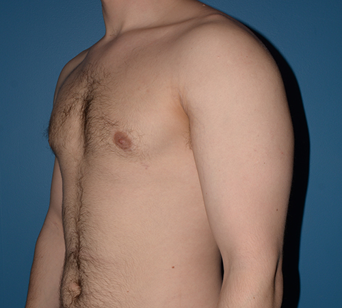 Male Breast Reduction