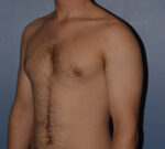 Male Breast Reduction