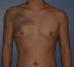 Male Breast Reduction