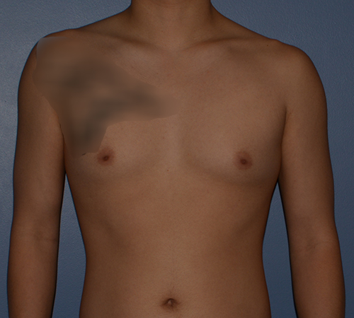 Male Breast Reduction