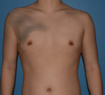 Male Breast Reduction