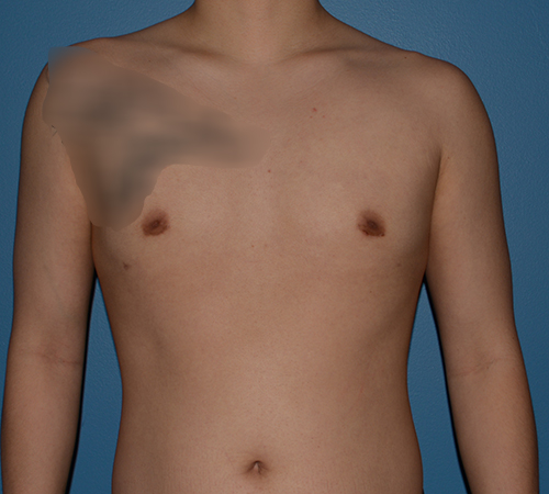 Male Breast Reduction