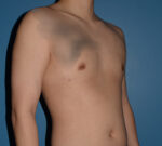 Male Breast Reduction