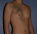 Male Breast Reduction