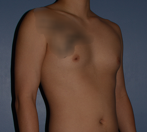 Male Breast Reduction