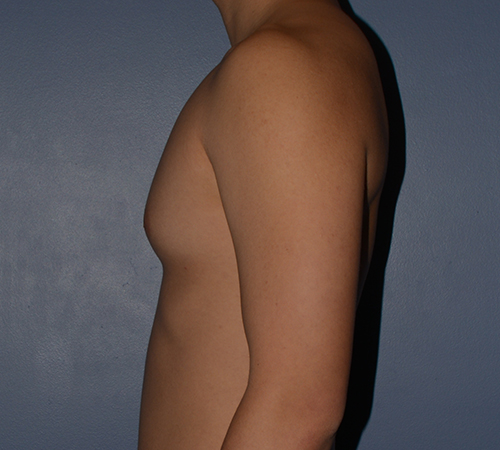 Male Breast Reduction