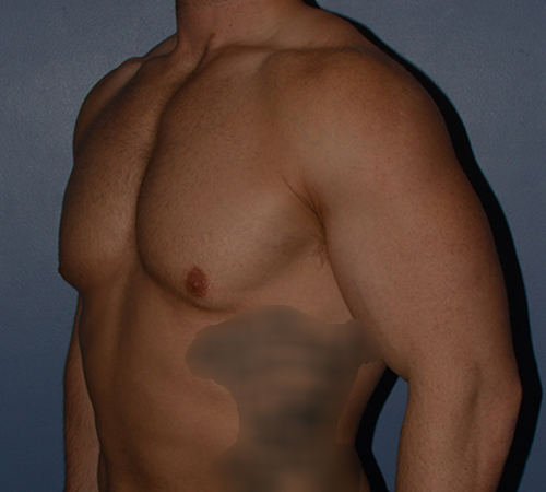 Male Breast Reduction