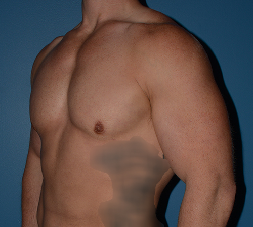 Male Breast Reduction