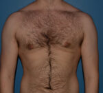 Male Breast Reduction