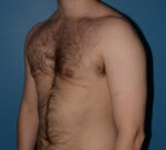 Male Breast Reduction