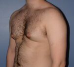 Male Breast Reduction