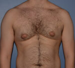 Male Breast Reduction