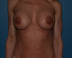 Breast Correction