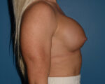 Breast Correction