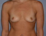 Breast Augmentation Implants