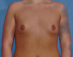 Breast Augmentation Implants